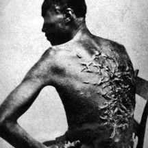 1863,  Louisiane cicatrices de flagellation sur un esclave
